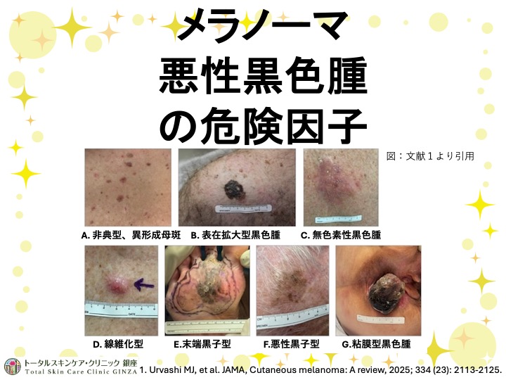 ホクロの癌〜メラノーマ(悪性黒色腫)の危険因子〜のアイキャッチ画像
